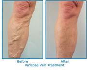 Effective Varicose Veins Treatment at Bedfordshire